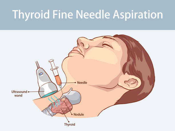 Fine Needle Aspiration (FNA) Biopsy