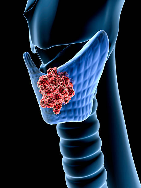 Follicular Neoplasm of Thyroid