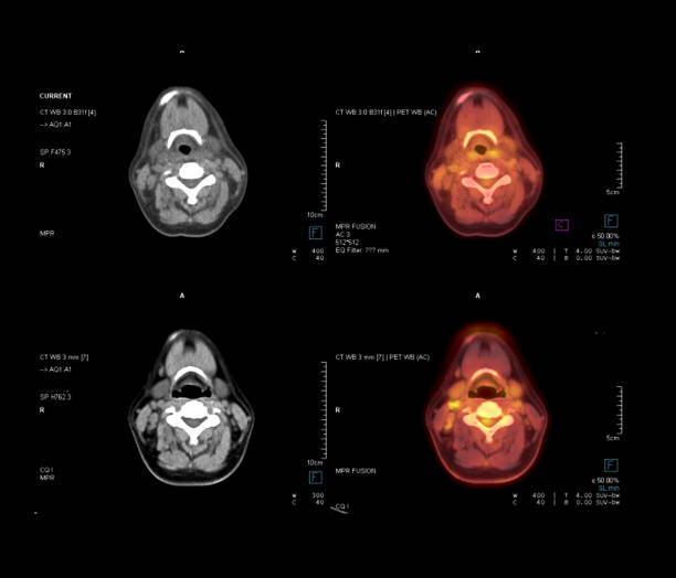 Thyroid Scans