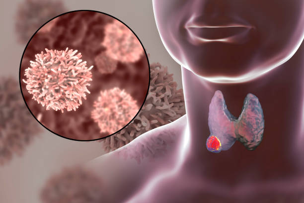 Hurthle Cell Carcinoma