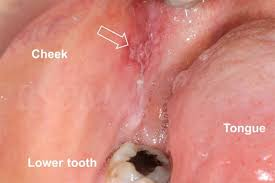 Understanding Buccal Mucosa Cancer