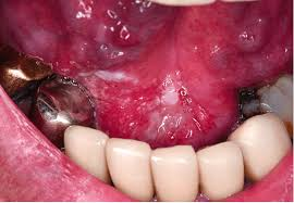 Floor of Mouth Cancer - Symptoms