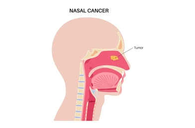 Side view diagram of the head showing nasal cancer with a labeled tumor in the nasal cavity.