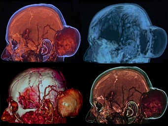 Side view diagram of the head showing nasal cancer with a labeled tumor in the nasal cavity.