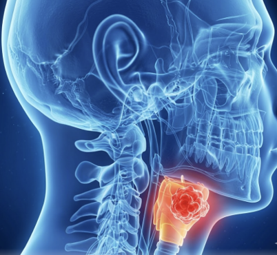 Side-view medical illustration highlighting a thyroid gland with a tumor in the neck area