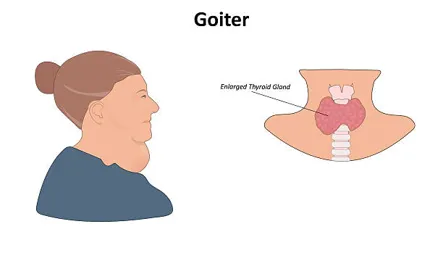 Goiter with enlarged thyroid gland | Head N Neck Surgery Side profile of a woman next to a labeled diagram showing an enlarged thyroid gland (goiter).