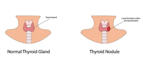 Normal thyroid vs thyroid nodule | Head N Neck Surgery Comparison of a normal thyroid gland (left) and a thyroid nodule (right) in a cross‑section of the neck.