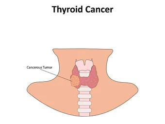 Thyroid cancer illustration | Head N Neck Surgery Diagram of the neck showing the thyroid gland with a highlighted cancerous tumor on one lobe.