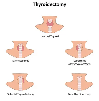 Infographic showing five thyroidectomy options: normal thyroid and four surgical variants (isthmusectomy, lobectomy/hemithyroidectomy, subtotal, and total thyroidectomy).