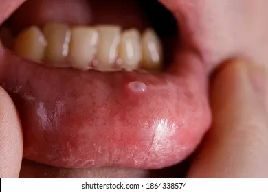 image1 | Head N Neck Surgery Close-up of a lower lip with a small blister or sore, with teeth visible above the lip.