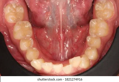 image15 | Head N Neck Surgery Close-up of the lower dental arch showing teeth and pink gums, with mild crowding of the front lower teeth.