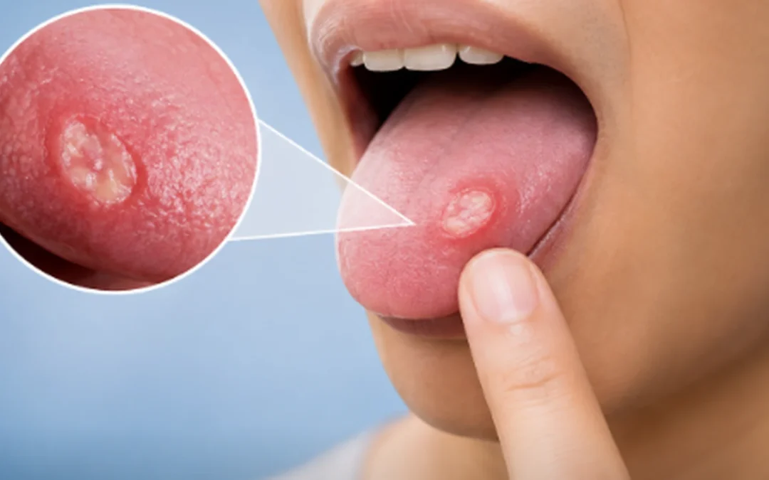 Tongue Ulcer That Won't Heal When Should You Worry About Cancer