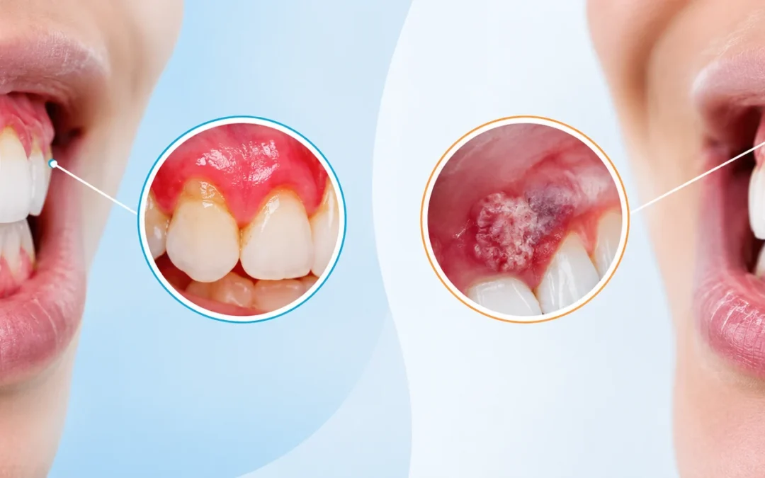Gum Cancer vs Gum Disease: How to Tell the Difference